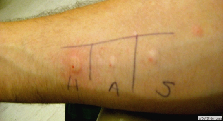 Intradermal skin testing for allergic reation