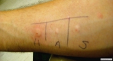 Intradermal skin testing for allergic reation