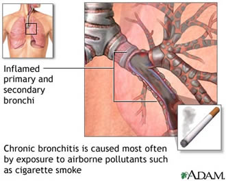 Diagram showing causes of chronic bronchitis
